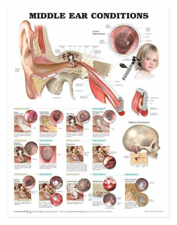 middle ear conditions