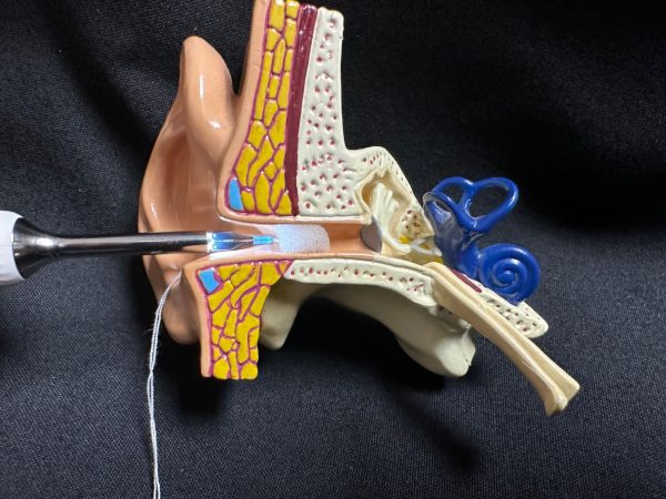 Closed tweezers for placing an otoblock on the EAR/BeBird Note5 otoscope.