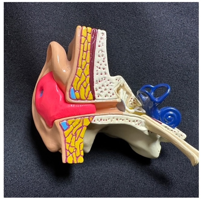 Custom ear mold shown in a model ear canal.
